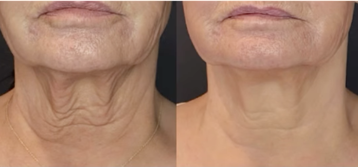3 Months Post Sofwave Treatment