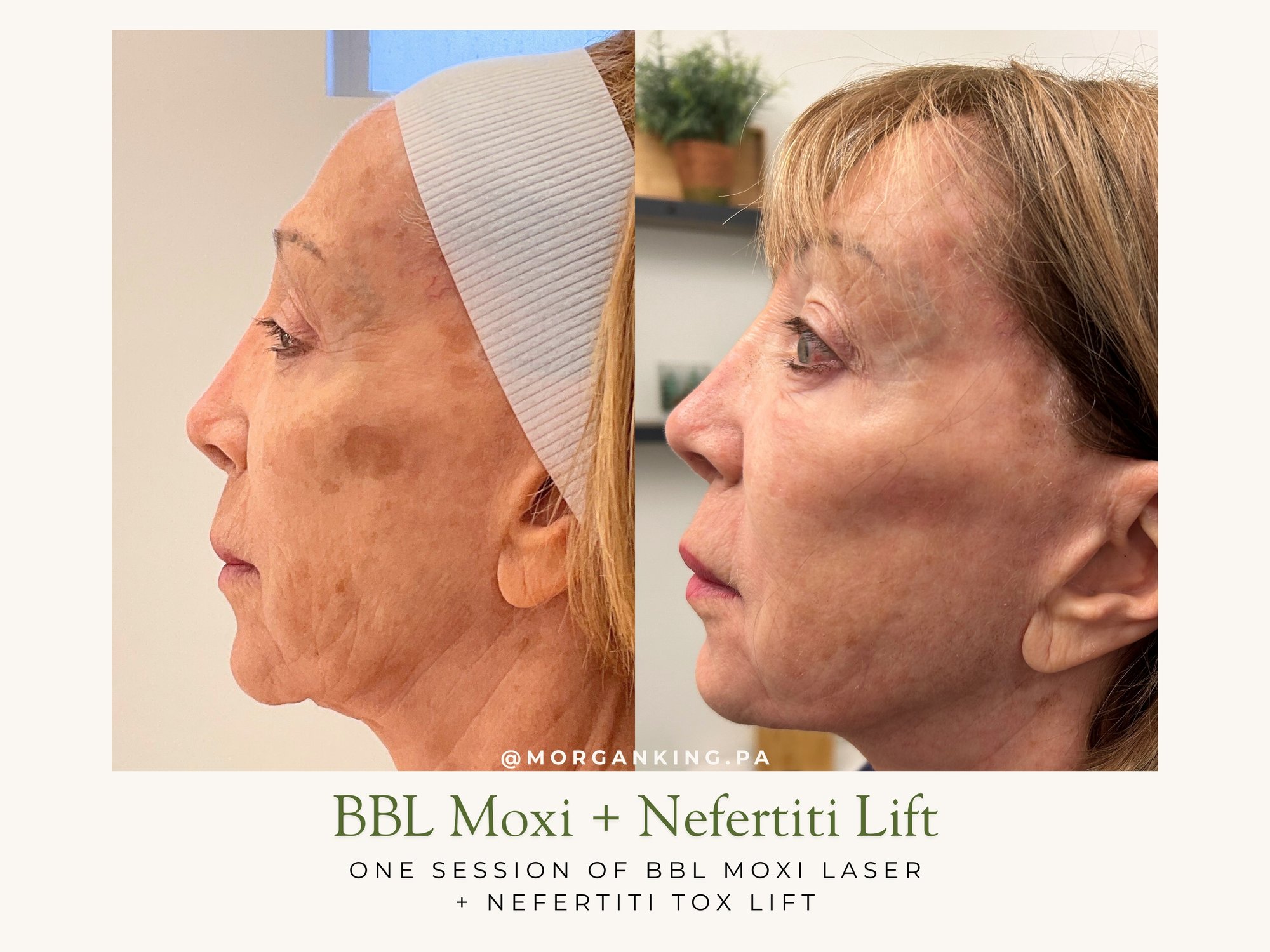 BBL Moxi Tox Lift - Morgan