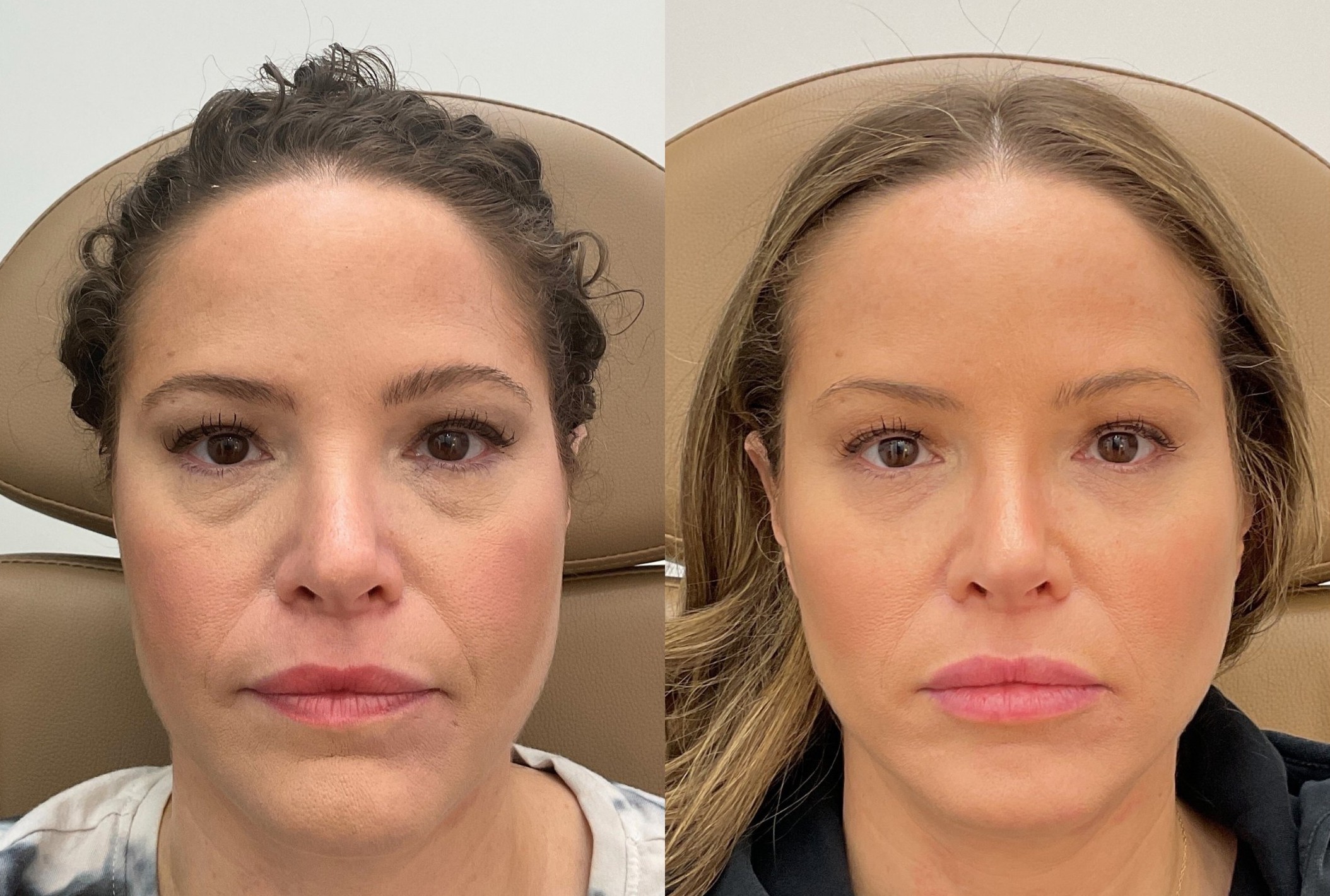Facial balancing filler before and after