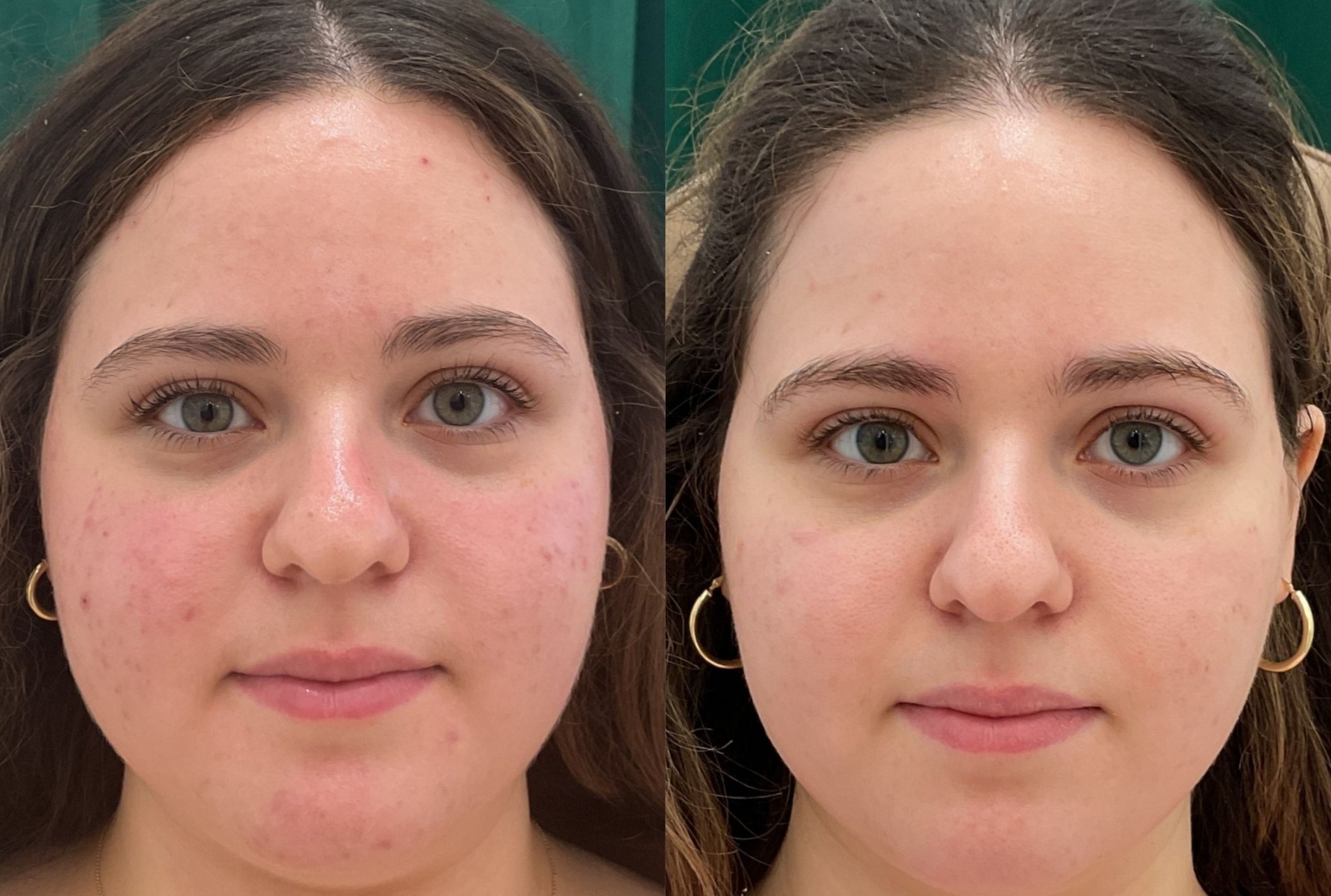 Microneedling before and after