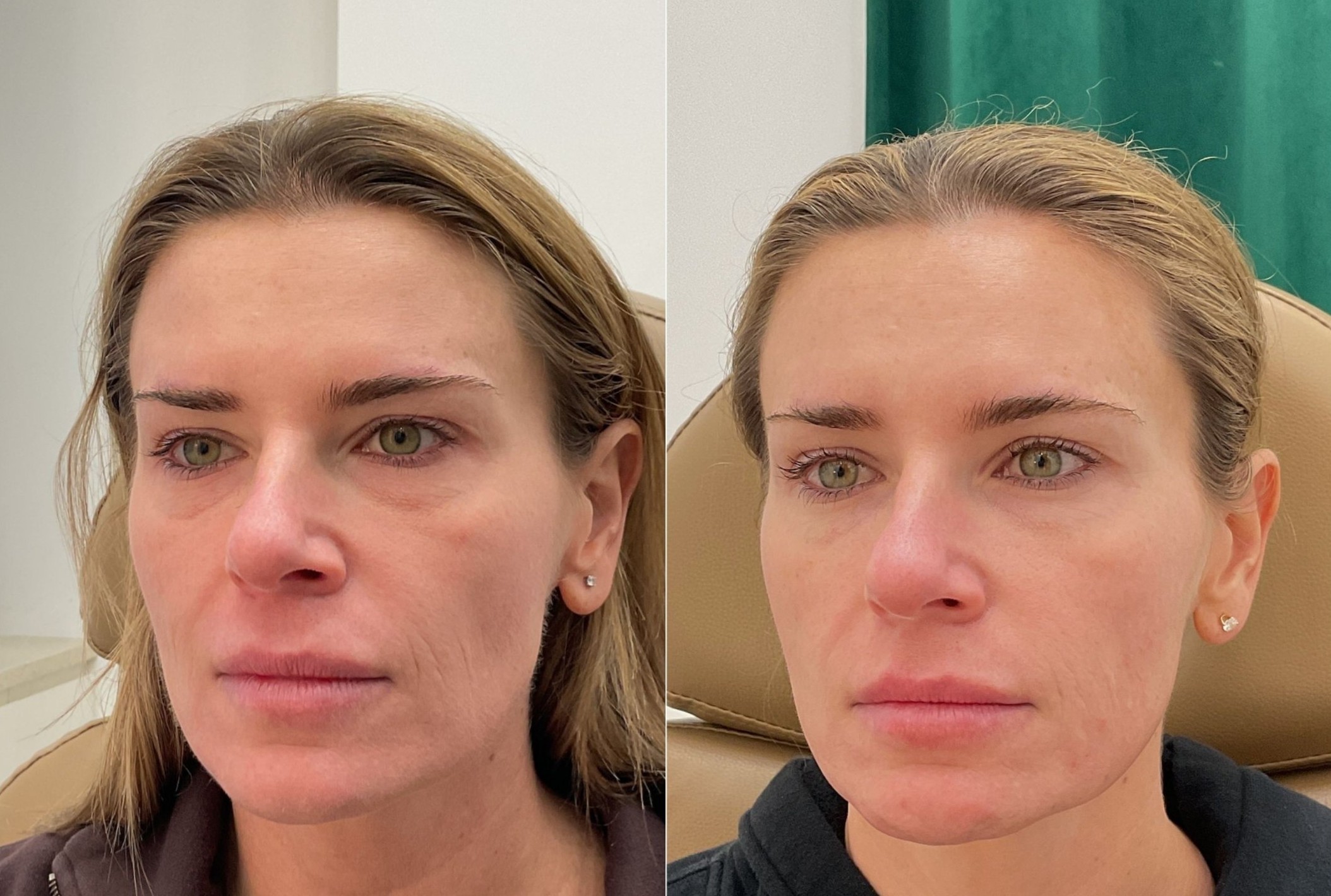 Sculptra before and after