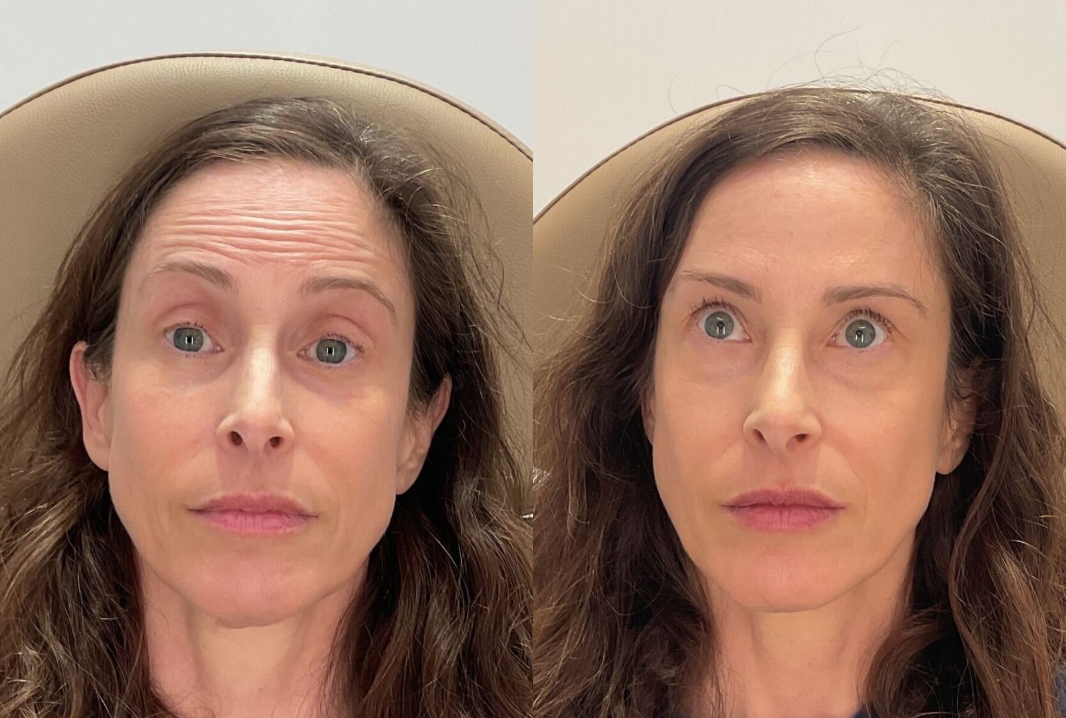 Wrinkle reducers before and after, forehead