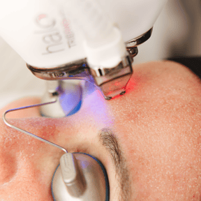 HALO® TRIBRID™ Laser