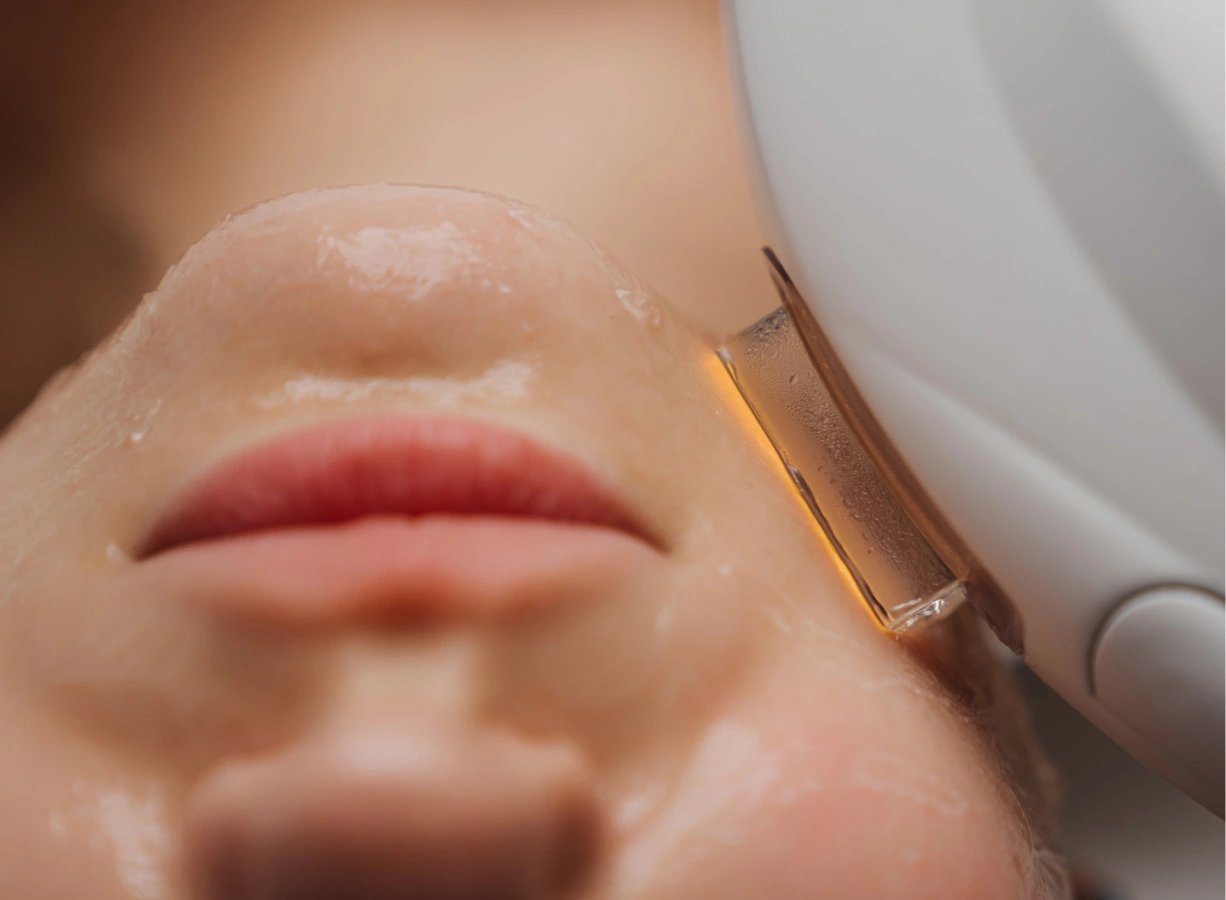 IPL-Treatment