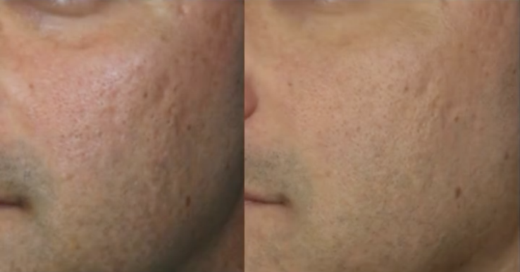 Sofwave Before & After Cheek