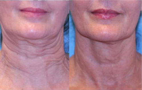 Sofwave 10 Months After Post 1 Treatment Before and After
