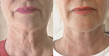 Sofwave 4 Months Post One Treatment
