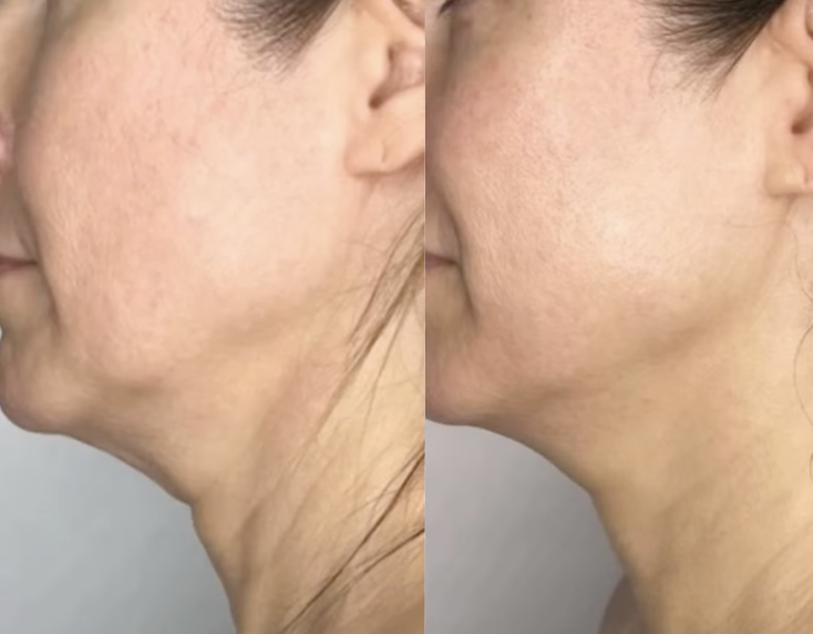 Sofwave Before & After 2
