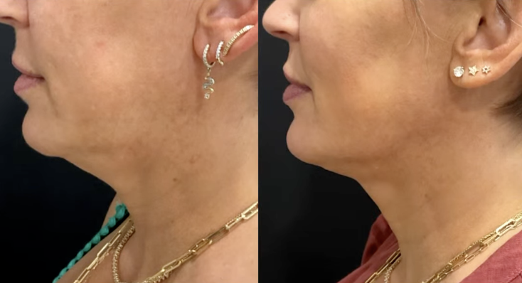 Sofwave Before & After 3