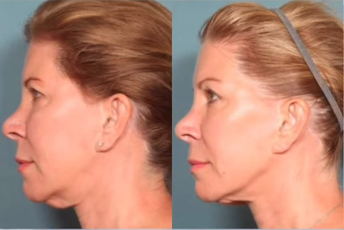 Sofwave Before & After
