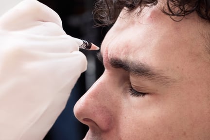 Botox (Wrinkle Reducers)