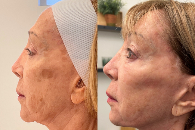 bblmoxi+nerfertitilift (1)