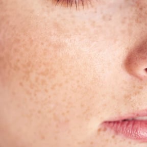 Broadband Light (BBL)