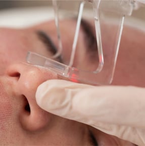 CO2 Resurfacing Laser