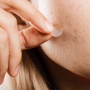 Cortisone Injection for Acne