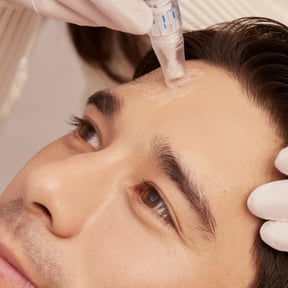 Microneedling