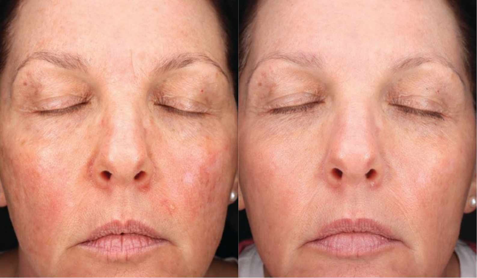 halo®_tribrid™_before_&_after_—_redness,_pigmentation_&_skin_texture