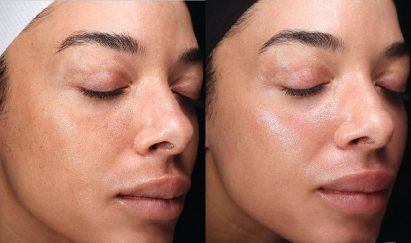 halo®_tribrid™_before_&_after_—_uneven_skin_tone_&_texture_on_deeper_skin